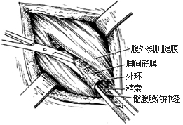 一般腹股沟斜疝修复术图片