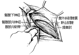 一般腹股沟斜疝修复术图片