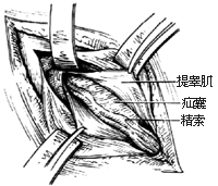 一般腹股沟斜疝修复术图片