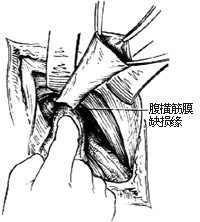 一般腹股沟斜疝修复术图片