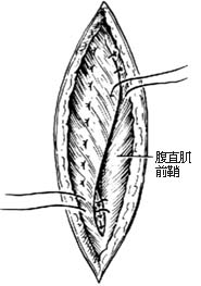 腹壁切口疝修复术图片