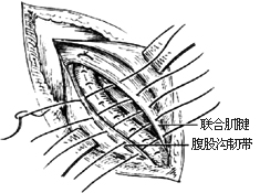 一般腹股沟斜疝修复术图片