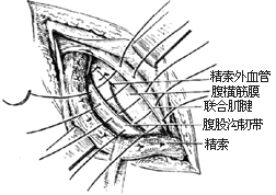 一般腹股沟斜疝修复术图片