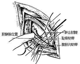 一般腹股沟斜疝修复术图片