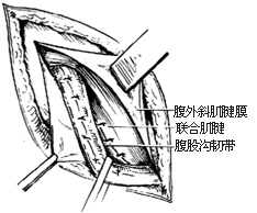 一般腹股沟斜疝修复术图片