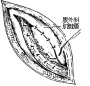 一般腹股沟斜疝修复术图片