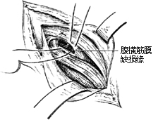 一般腹股沟斜疝修复术图片