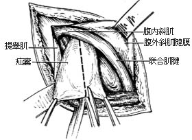 滑疝修复术图片