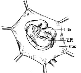 滑疝修复术图片