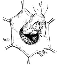 滑疝修复术图片