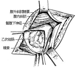 滑疝修复术图片