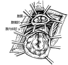 滑疝修复术图片