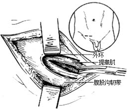 小儿腹股沟斜疝修复术图片