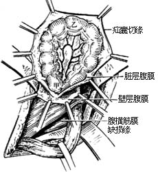 滑疝修复术图片