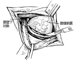 腹股沟直疝修复术图片