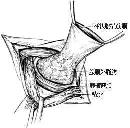腹股沟直疝修复术图片