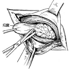 腹股沟直疝修复术图片