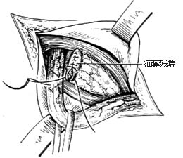 腹股沟直疝修复术图片