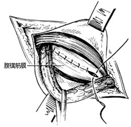 腹股沟直疝修复术图片
