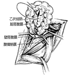 滑疝修复术图片