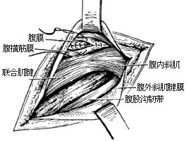 滑疝修复术图片