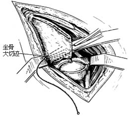 髋骨旋转切骨术图片