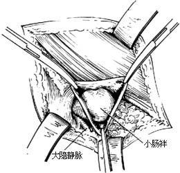 股疝修复术图片