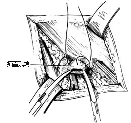 股疝修复术图片