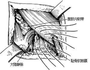 股疝修复术图片