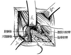 股疝修复术图片