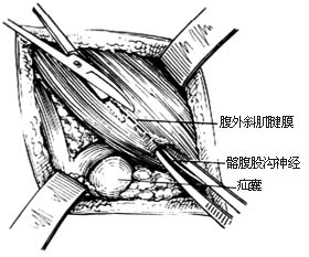 经腹股沟股疝修复术图片