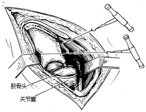 髋骨旋转切骨术图片