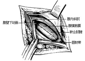 经腹股沟股疝修复术图片