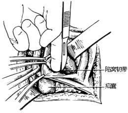 经腹股沟股疝修复术图片