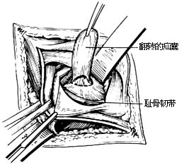 经腹股沟股疝修复术图片