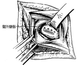 经腹股沟股疝修复术图片