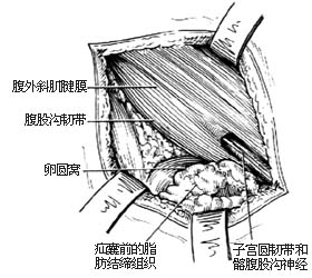 股疝修复术图片