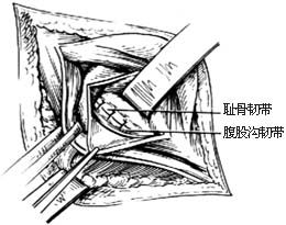 经腹股沟股疝修复术图片
