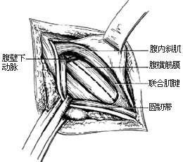 经腹股沟股疝修复术图片