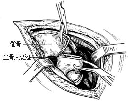 髋骨旋转切骨术图片