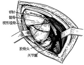 髋骨旋转切骨术图片