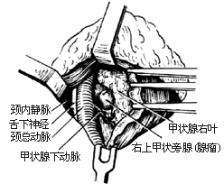 甲状旁腺切除术图片