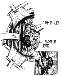 甲状旁腺切除术图片