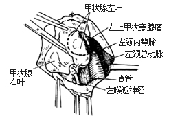 甲状旁腺切除术图片