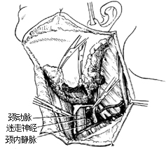 甲状腺癌根治术图片