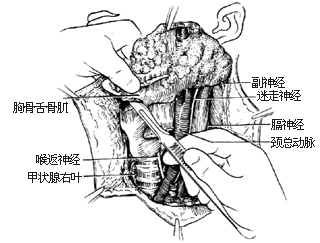 甲状腺癌根治术图片