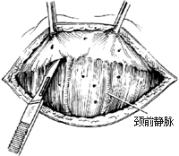 甲状腺次全切除术图片