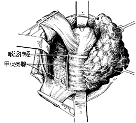 甲状腺全切除术图片