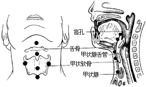 甲状腺舌管囊肿（瘘）切除术图片