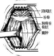 甲状腺舌管囊肿（瘘）切除术图片